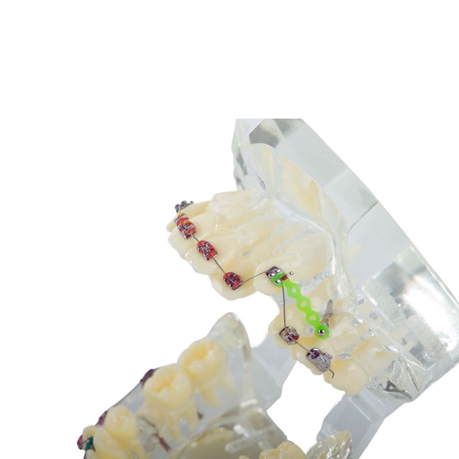 Model aparat dentar cu bracketi pentru anatomia maxilarului si dintilor, Transparent - KESNUP